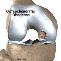Osteocondritis disecante de rodilla en corredores 4 Osteocondritis disecante de rodilla en corredores 1