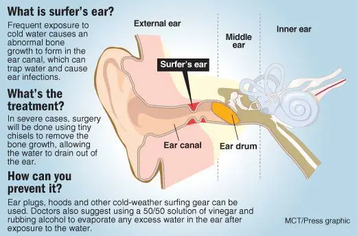 Todo lo que necesitas saber sobre El Oído de Surfista 6 Hearing loss explainer