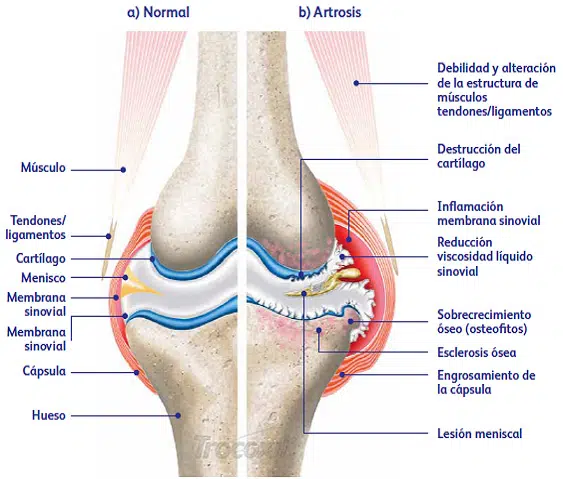 Condroitina y Glucosamina 4 artrosis de rodilla